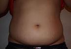Why does not leave fat from the abdomen in women
